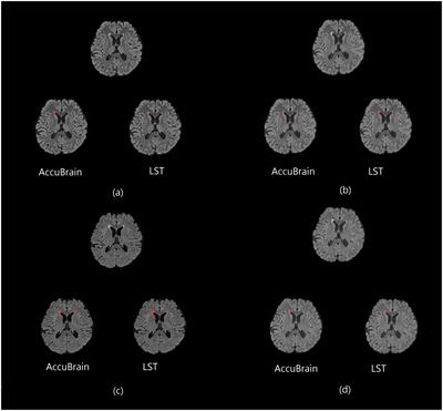 Intra-Scanner and Inter-Scanner Reproducibility of Automatic White Matter Hyperintensities Quantification